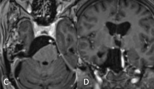 岩斜区脑膜瘤术后图片