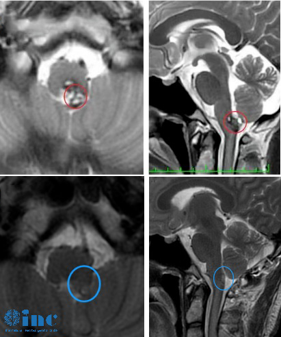 19岁男孩-延髓海绵状血管瘤图片