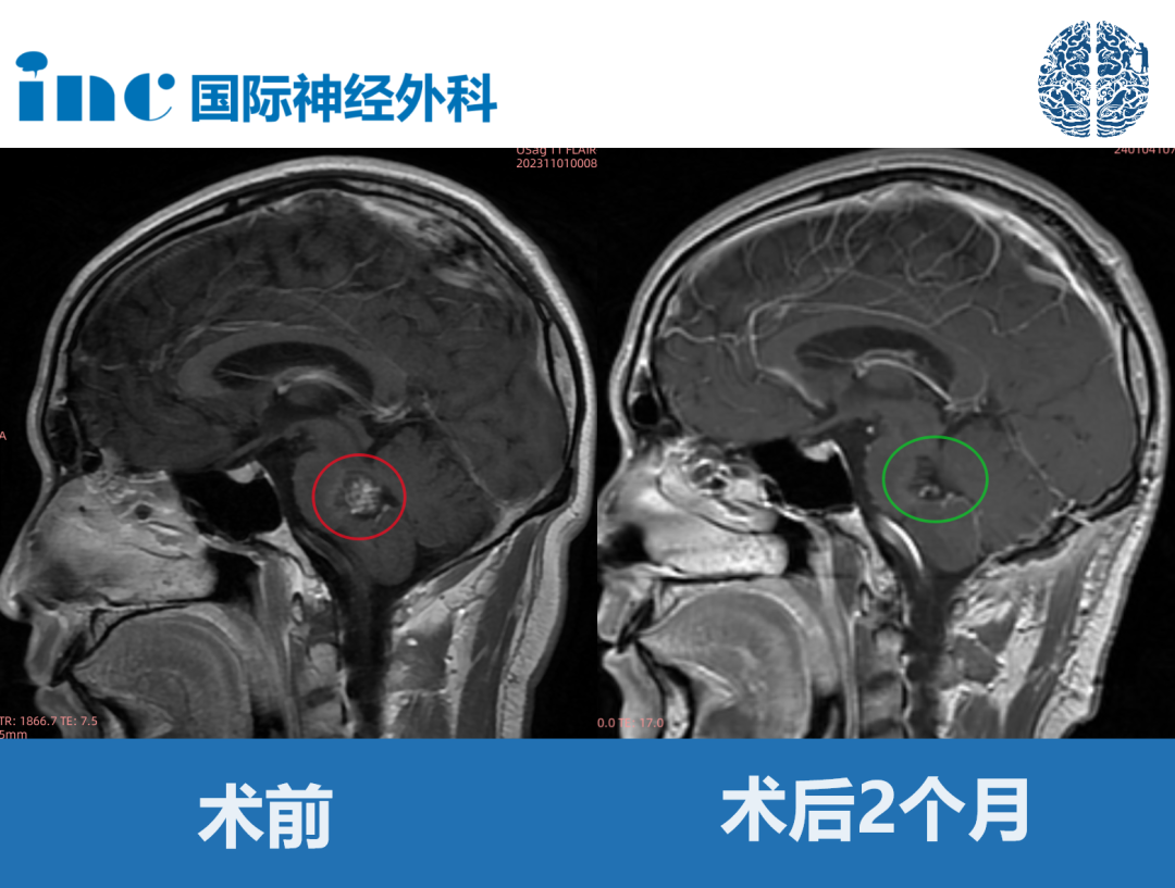 30岁男性-脑干海绵状血管瘤案例图片