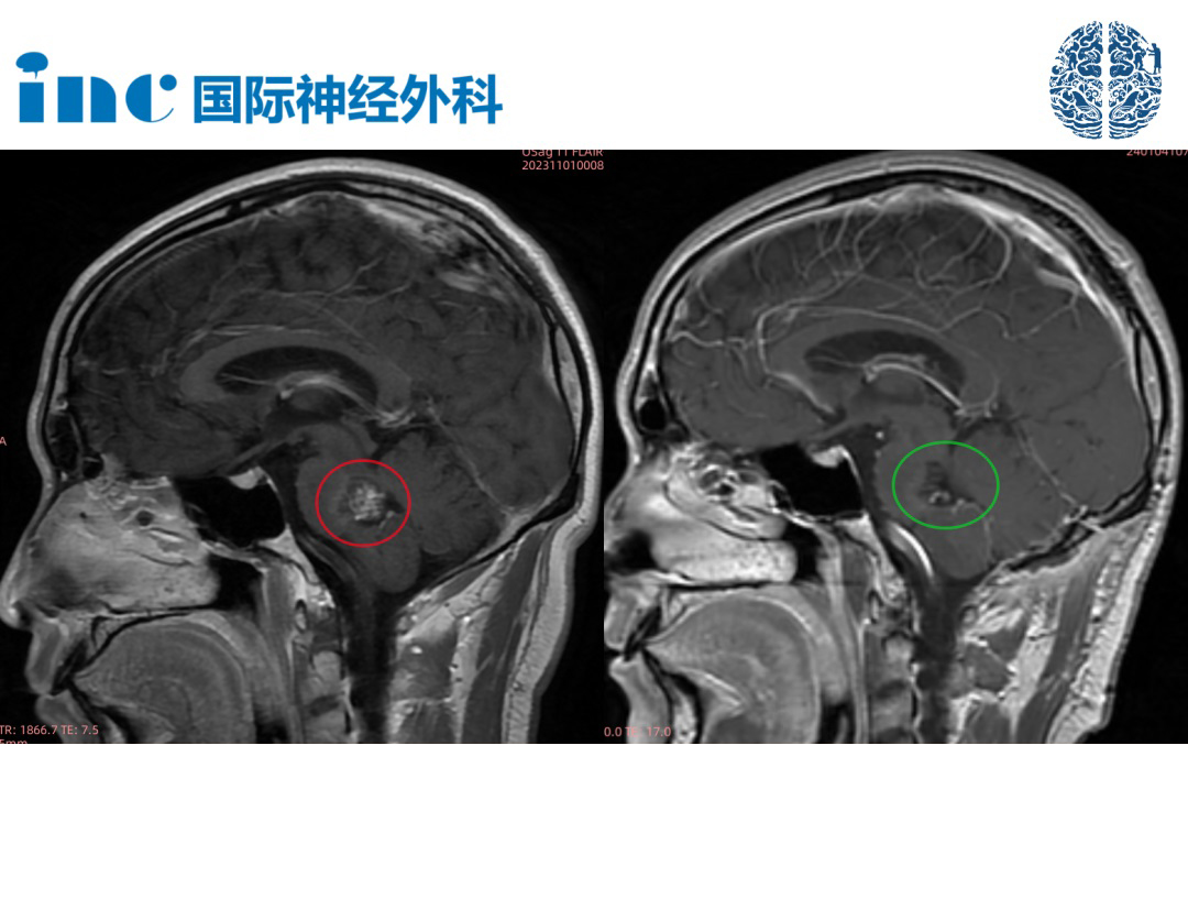 30岁男性-脑干海绵状血管瘤案例图片