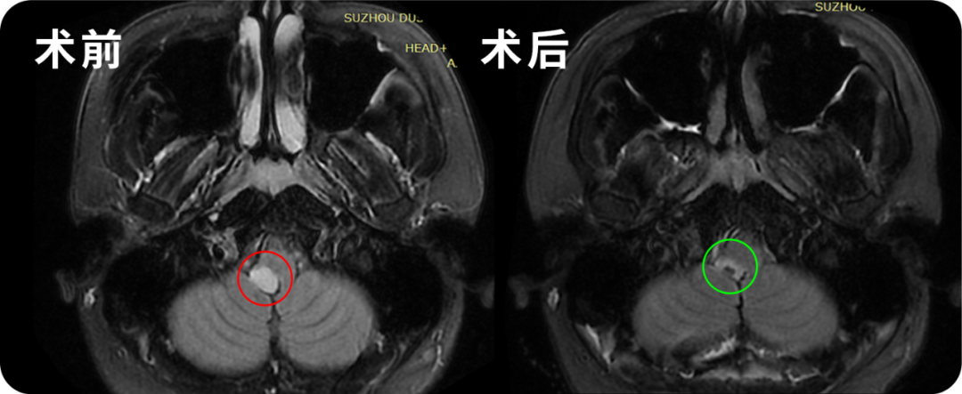 24岁男性-脑干延髓低级别胶质瘤图片