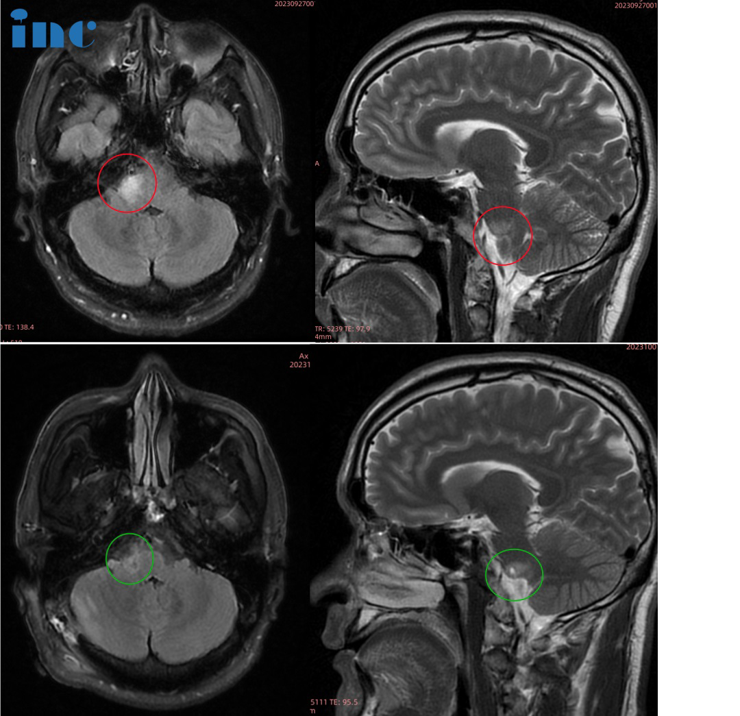 33岁男性•脑干-桥臂胶质瘤图片