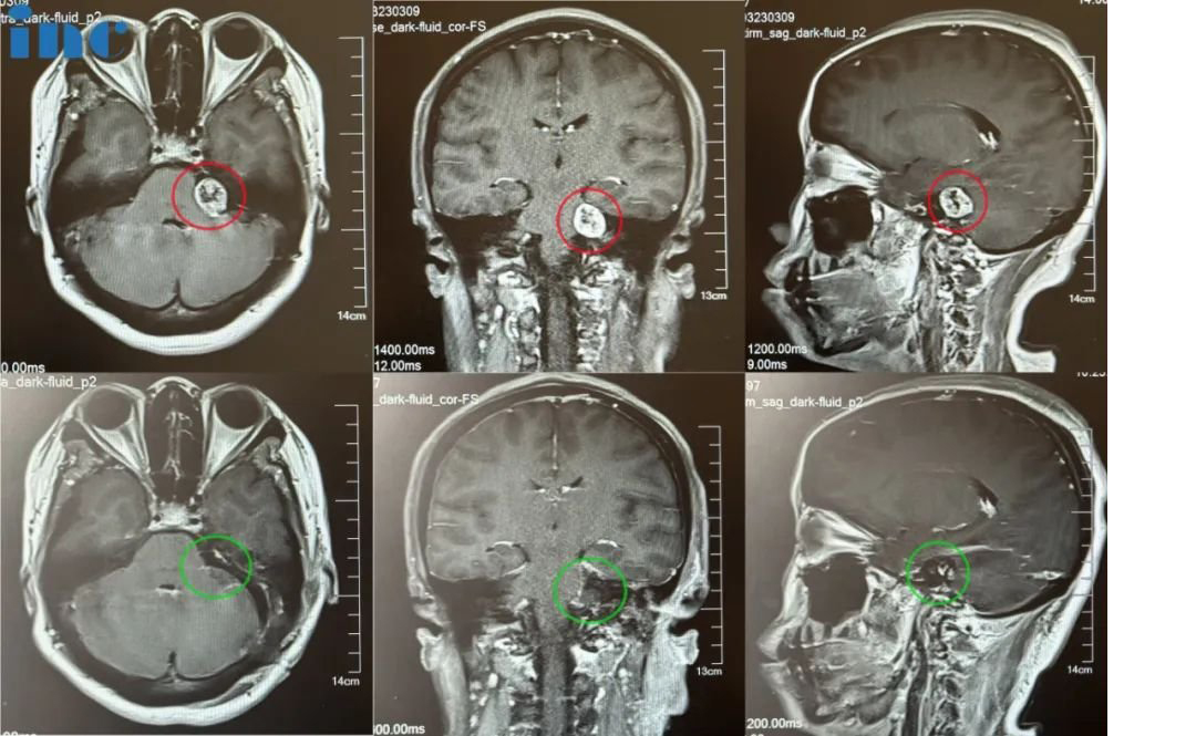 46岁女性-听神经瘤图片