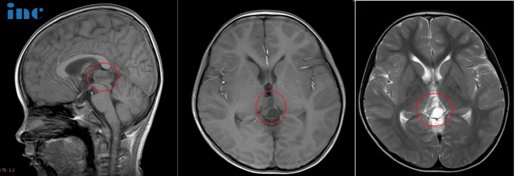 6岁男孩-松果体占位性病变图片