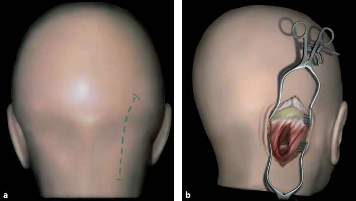 轻度弯曲的皮肤手术切口（a）和使用两个自持式牵开器（b）在初始阶段进行的手术暴露图片