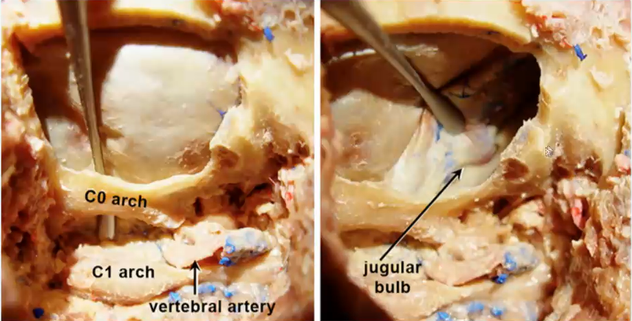尸解显示类似于上图所示的手术视野暴露，枕骨大孔的背缘（“C0”弓）留在原位，将硬脑膜与此缘分离（a）。其余枕骨外侧鳞片、枕骨大孔外侧缘、颈静脉突和寰枕关节内侧部分对应于随后切除的区域，即经髁入路的关键点（b）