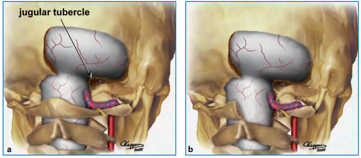 切除枕骨大孔后缘（所谓的“C0”半椎板切除术）和部分钻取枕髁和颈静脉结节后典型暴露的图示；这种暴露可以不进行（a）或包括（b）C1半椎板切除术
