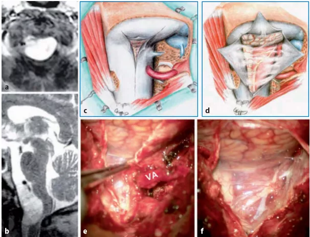 图13.13 a，b术前MR图像（T1-W增强扫描，b矢状T2-W）显示一个大的枕大孔脑膜瘤，该脑膜瘤向背侧生长，严重压迫颈髓。c、图示硬脑膜切开，肿瘤的背外侧和腹侧部分暴露，通过侧面反射硬脑膜和椎动脉的远端V3部分。e、f相应的术中照片显示通过侧面反射硬脑膜，可以直接接触到肿瘤基底的硬脑膜（VA，椎动脉）