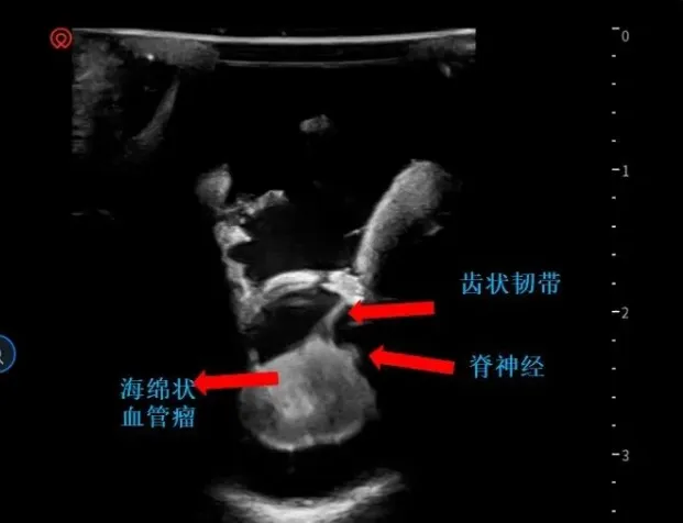 巴特朗菲教授手术图片——术中超声定位海绵状血管瘤(白色)