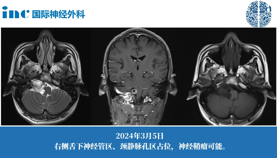 颈静脉孔区神经鞘瘤案例图片