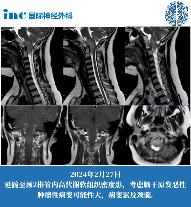 13岁男性-延髓占位性病变案例图片