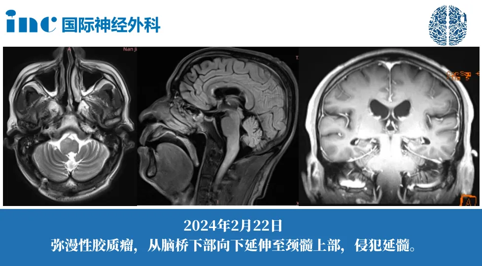 64岁男性-脑干胶质瘤（穿刺活检放化疗后）、肺部感染图片