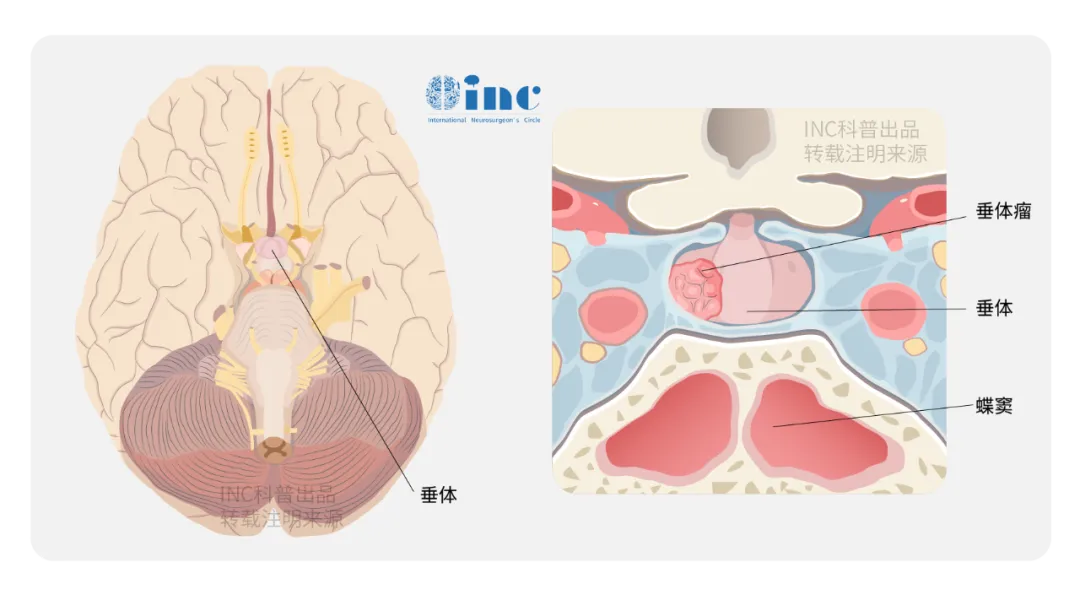 较大垂体瘤耐药又术后复发、面临失明，还能再手术、拯救视力吗？