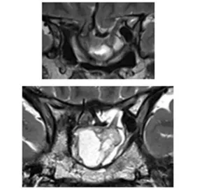 侵袭性垂体瘤实例分享——影像显示第一次肿瘤切除8年后复发，并伴有脑出血和鞍底下陷
