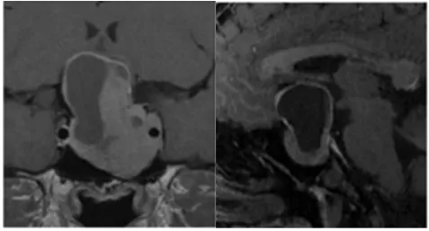 侵袭性垂体瘤实例分享——病灶图片