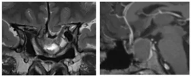 侵袭性垂体瘤实例分享——术前MRI显示第二次手术后肿瘤残余、患者出现继发性空蝶鞍综合征的影像学特征