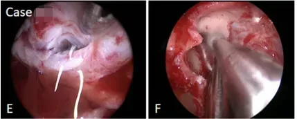 较大垂体瘤耐药又术后复发图片