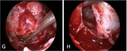 较大垂体瘤耐药又术后复发图片