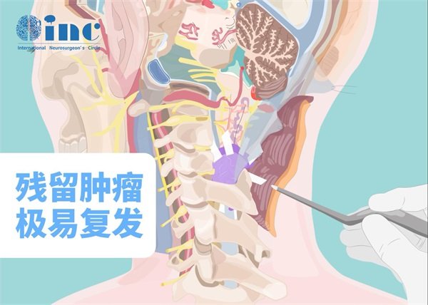 脊髓肿瘤复发的症状有哪些图片