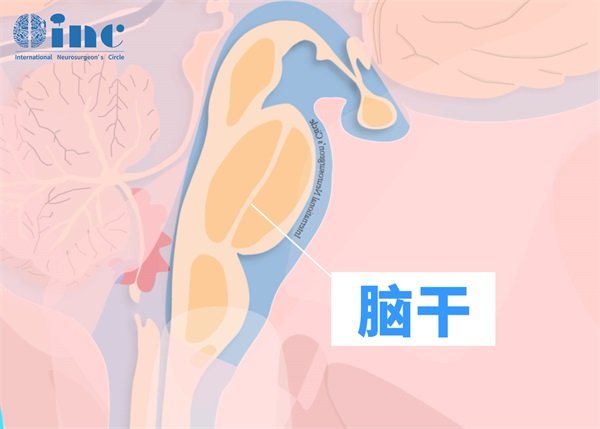脑脚间窝<a href='/bingzhong/jiaozhiliu/' target='_blank'><u>胶质瘤</u></a>手术风险图片