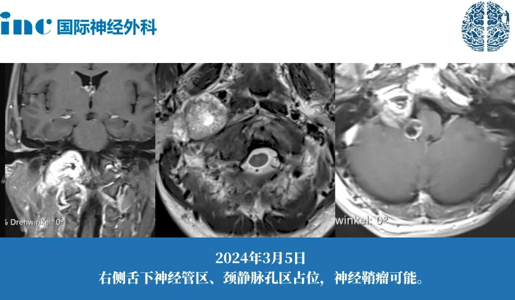 38岁男性-颈静脉孔区神经鞘瘤案例图片