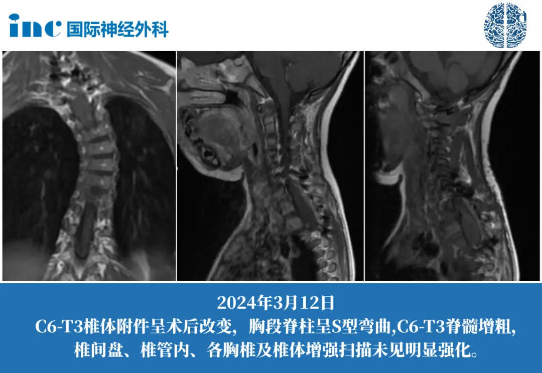 4岁女孩--脊髓节细胞胶质瘤案例图片