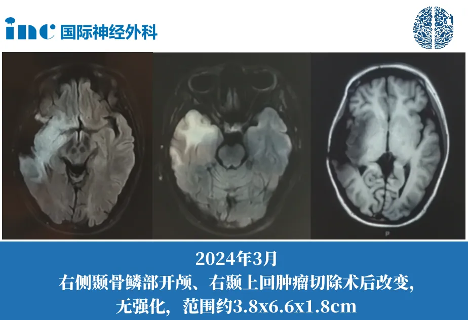 岛叶、颞叶、额叶较大胶质瘤手术是首要选择