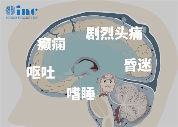 局灶性胶质瘤图片