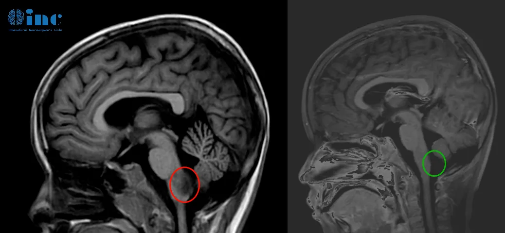 6岁男孩——脑干-延髓毛细胞星形细胞瘤影像图片