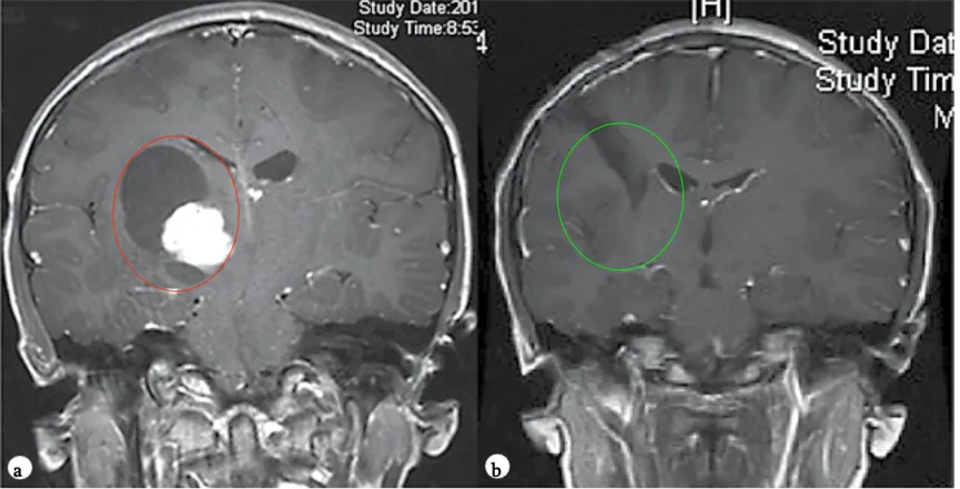 9岁女孩——丘脑毛细胞星形细胞瘤影像图片