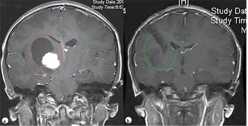 9岁女孩——丘脑毛细胞星形细胞瘤影像图片