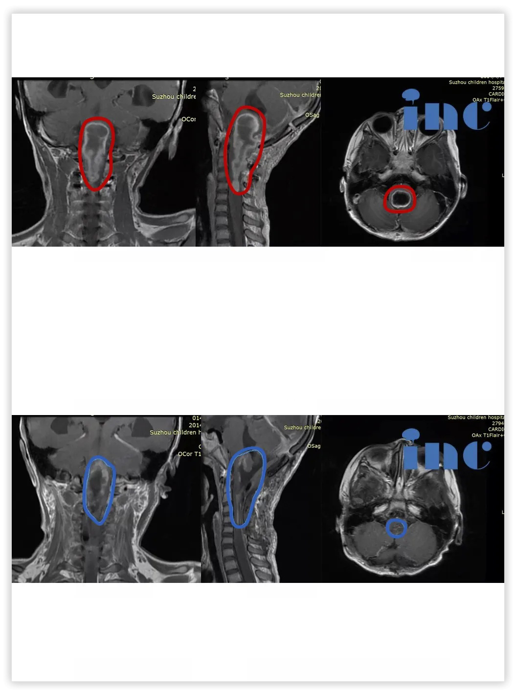 5岁女孩——脊髓-脑干毛细胞星形细胞瘤影像图片