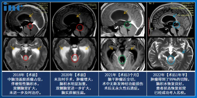 14岁男孩——脑干-中脑顶盖毛细胞星形细胞瘤影像图片