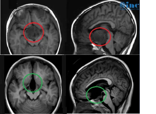 6岁男孩——视神经-毛细胞星形细胞瘤影像图片