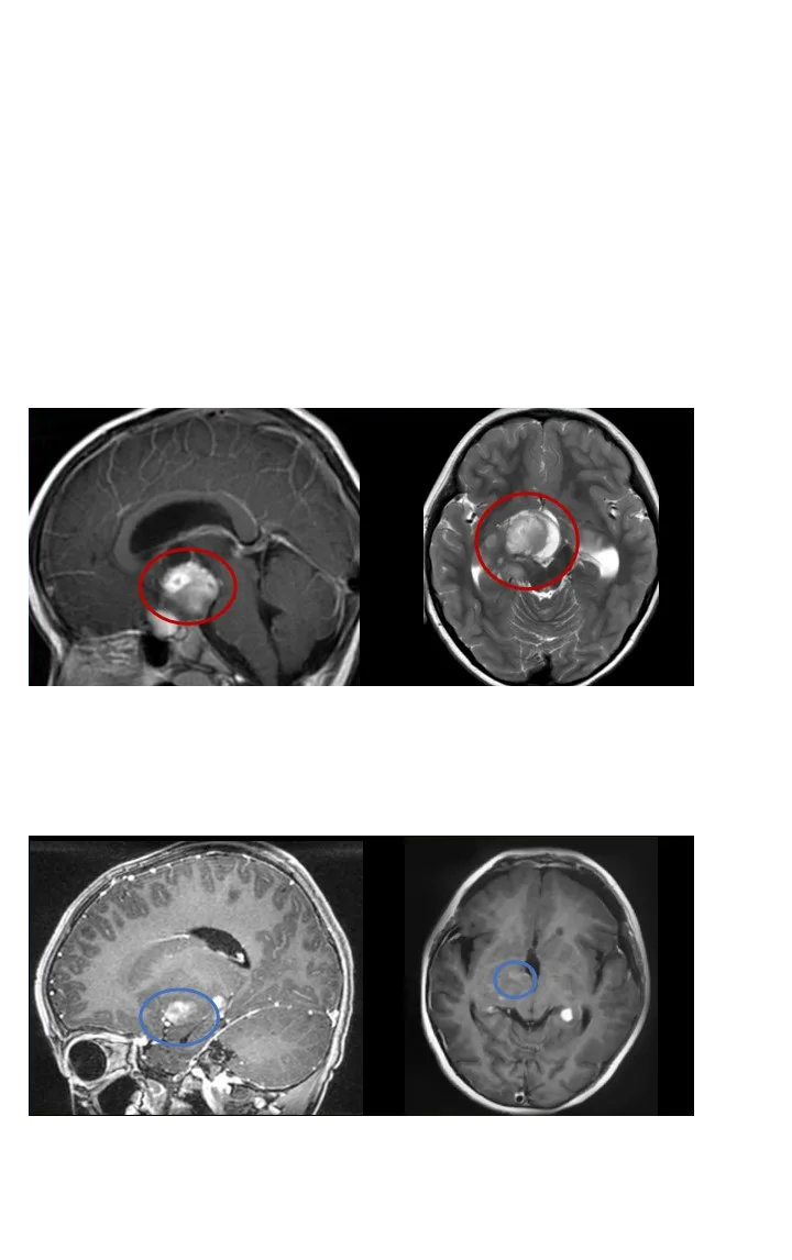 毛细胞粘液样型星形细胞瘤手术案例图片