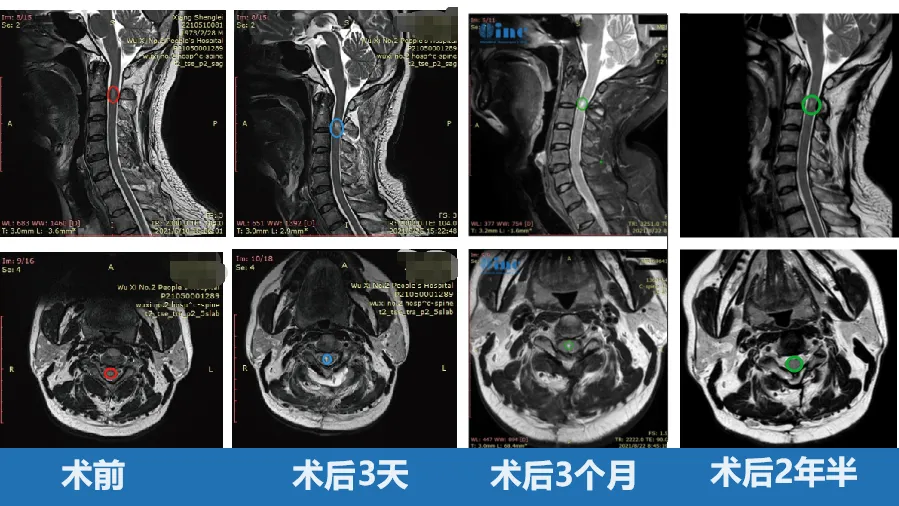 50岁男性——脊髓髓内室管膜瘤图片