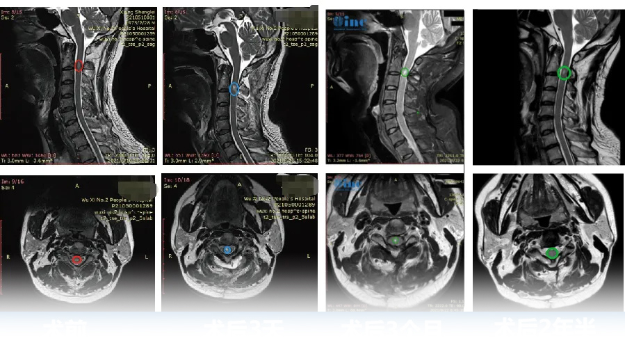 50岁男性——脊髓髓内室管膜瘤图片