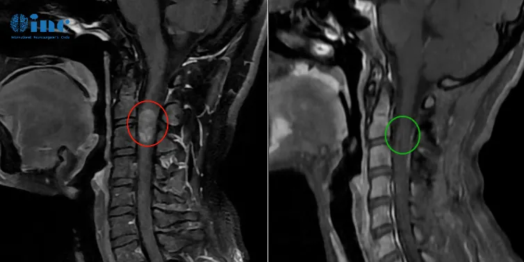 28岁女性脊髓髓内室管膜瘤影像图片