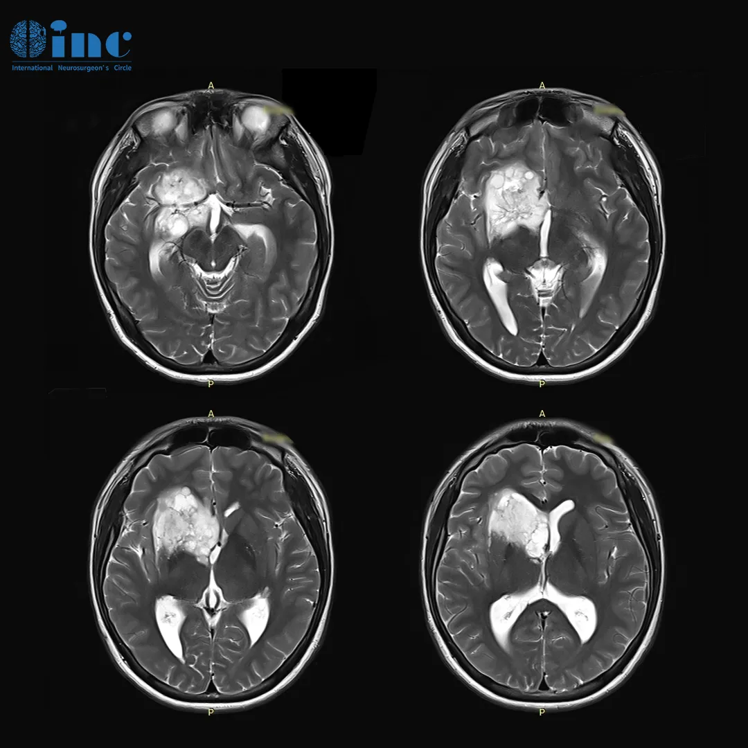 小磊术前MRI影像显示右额、颞、基底节区、侧脑室前角区占位