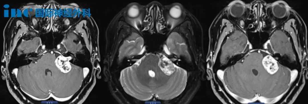 52岁女性-左侧较大听神经瘤案例图片