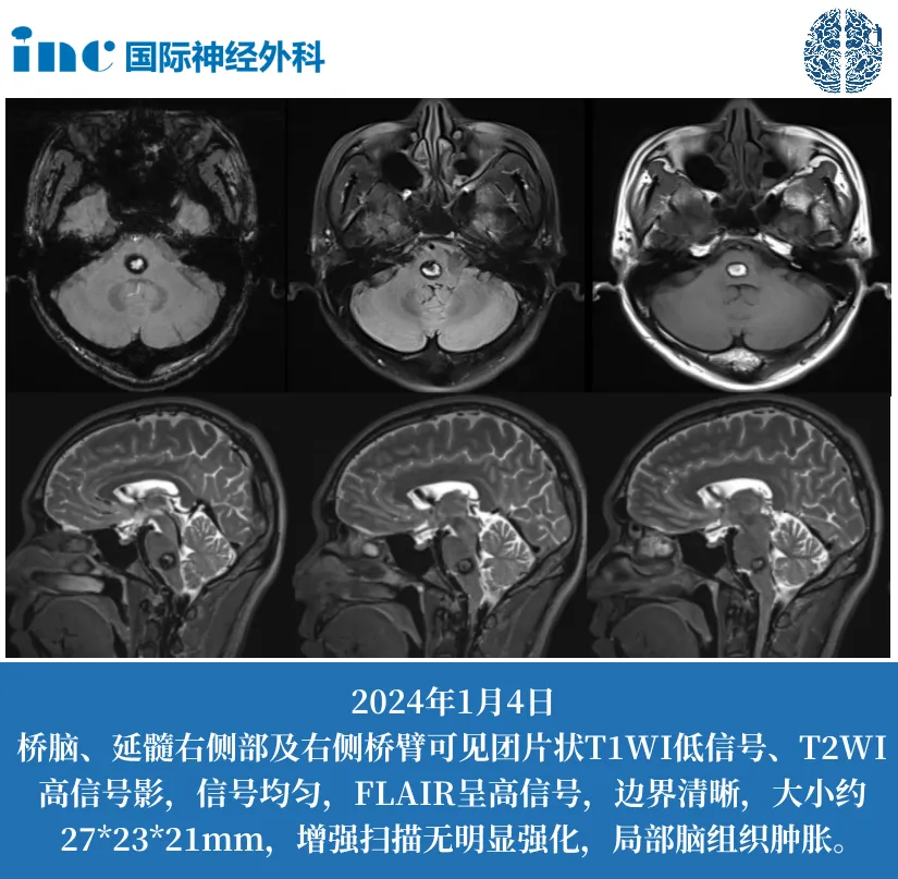 脑海绵状血管瘤患者术前影像图片