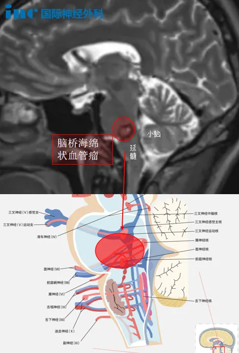 脑海绵状血管瘤图片