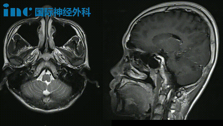 病灶位于桥脑左侧，并且与桥臂的交界处，病灶大，位置深。如果手术可能会有后遗症，如面瘫，右耳听觉丧失，共济失调等。