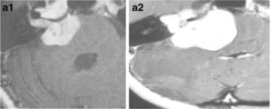 a-38岁女性。a-1增强后轴向MRI显示右侧中等大小的肿瘤(伽马刀治疗前)。a-2增强后轴向MRI显示肿瘤生长压迫脑干和小脑(伽马刀治疗后2年)。