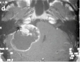 d-44岁女性。增强后轴向MRI显示右侧中等大小的肿瘤，有明显的囊肿形成(伽马刀治疗后2年)。
