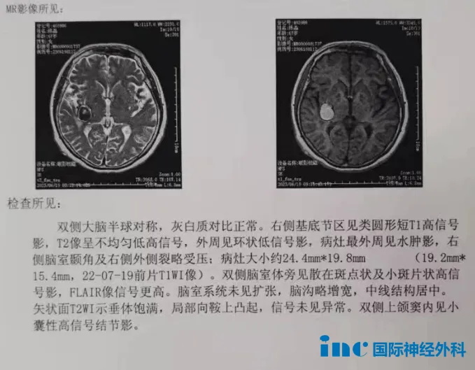 68岁女性--罹患基底节海绵状血管瘤