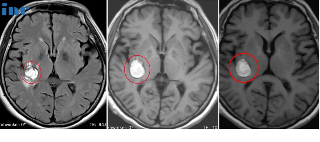 68岁女性--罹患基底节海绵状血管瘤