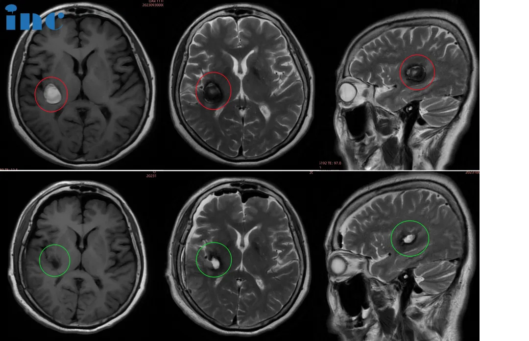 68岁女性--罹患基底节海绵状血管瘤——手术后