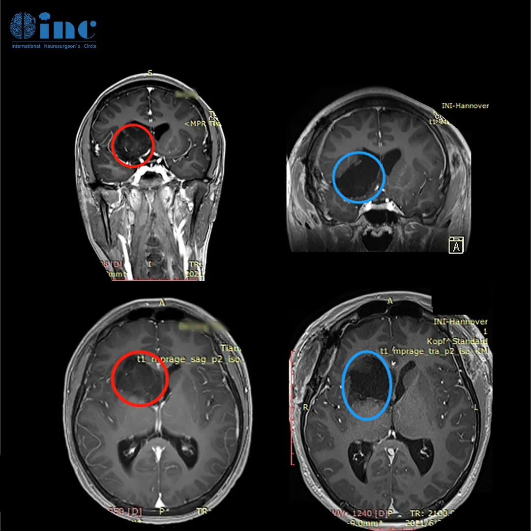 16岁男孩--基底节胶质瘤术后