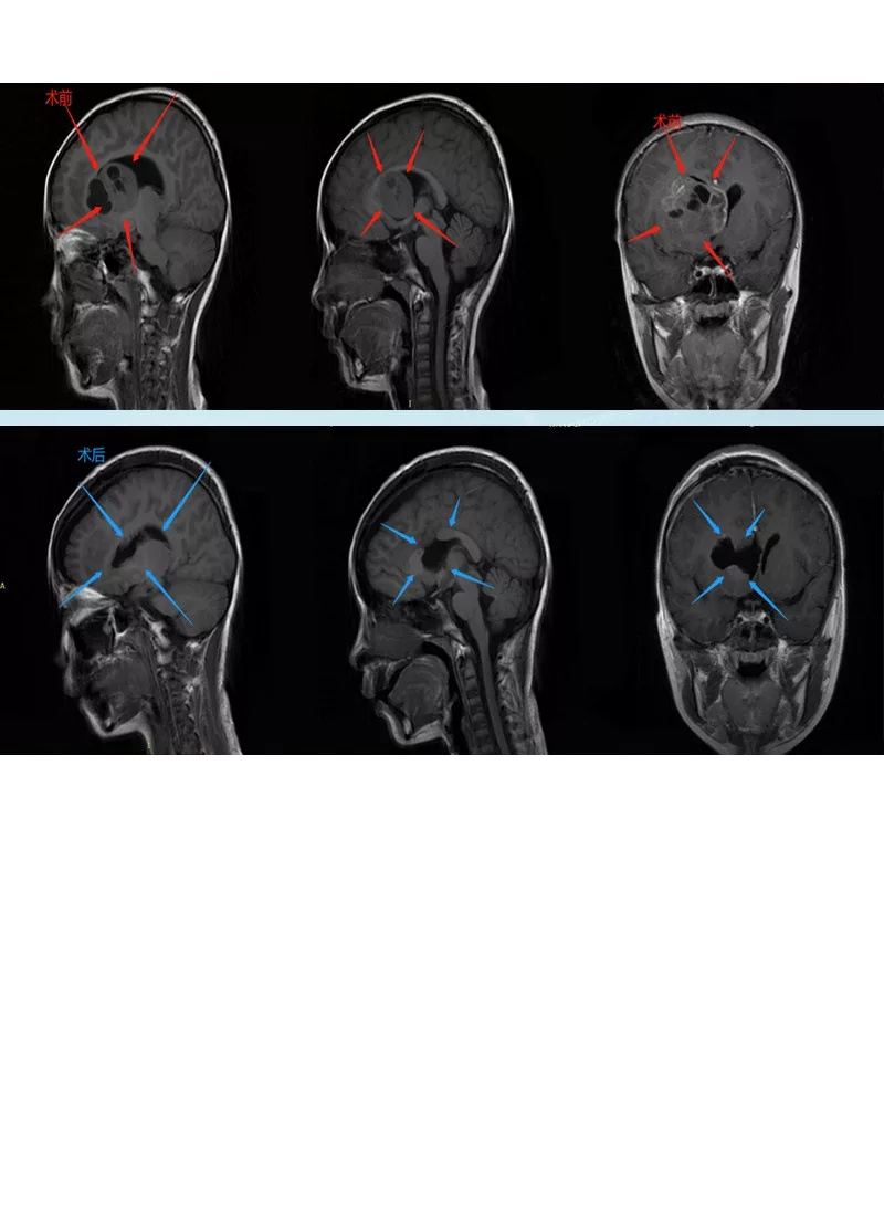 16岁男孩--基底节胶质瘤真实案例